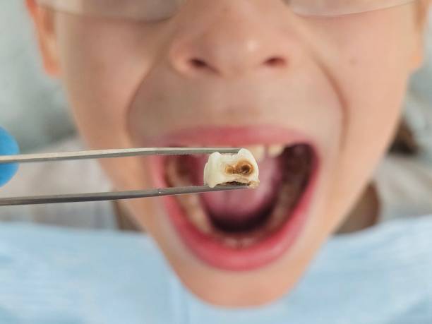 Best Broken or Cracked Tooth Emergency Dentist in Port Hadlock Irondale, WA
